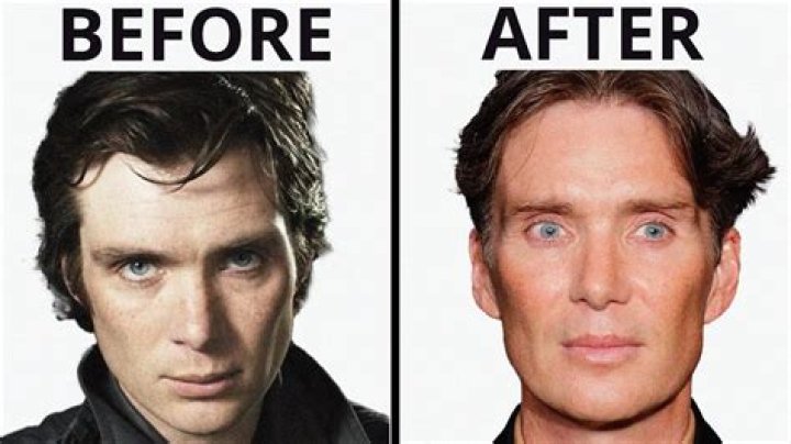Does Cillian Murphy's Youthful Appearance Result From Botox?
