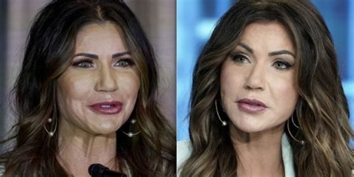 Kristy Noem's Plastic Surgery Revelations