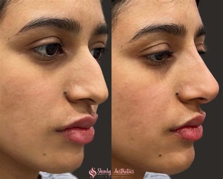 Nose Surgery And Botox Secrets