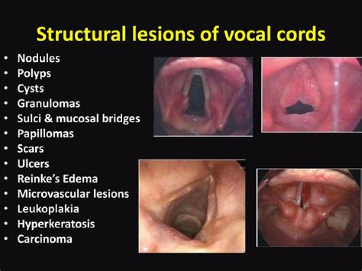 Randy Travis' Vocal Cord Disorder: Unraveling The Mystery