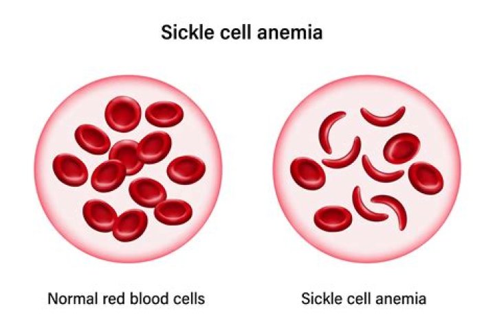 Sickle Cell Insights From Diane Abbott And James Thompson