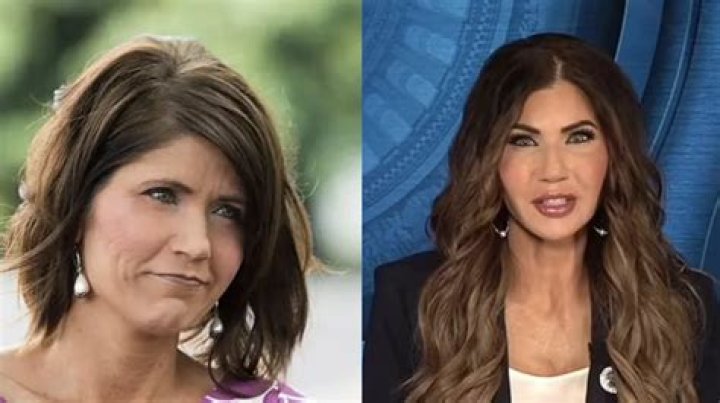The Truth Behind Kristie Noem's Plastic Surgery