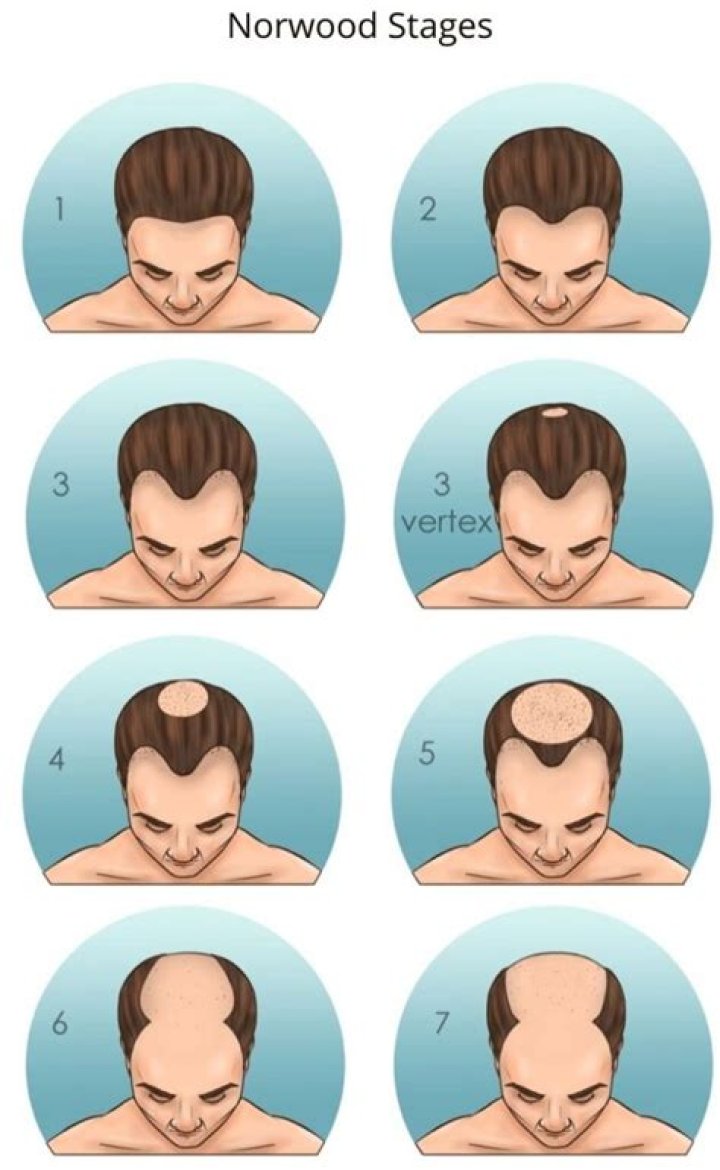 Ultimate Guide To Cartoon Characters With Receding Hairlines