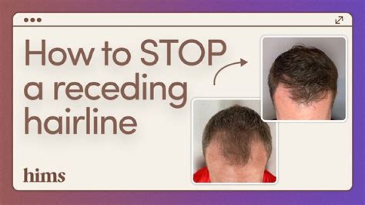 Why A Receding Hairline Can't Stop This Cartoon Character